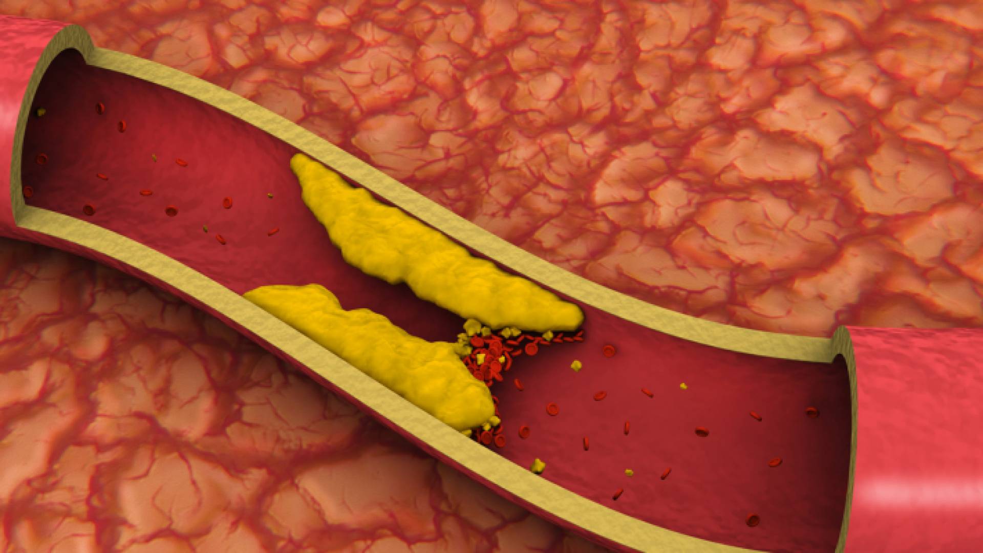 مقطع توضيحي لـ"الكوليسترول" في الجسم