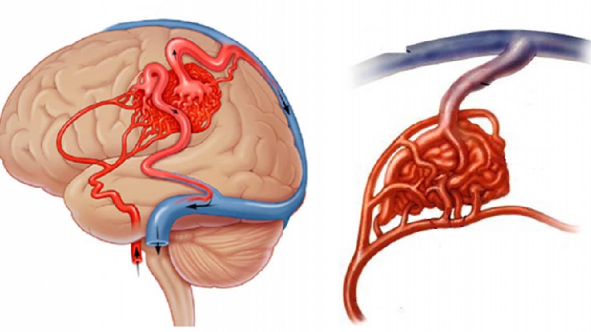 رسم توضيحي لناصور شرياني وريدي مباشر في الدماغ
