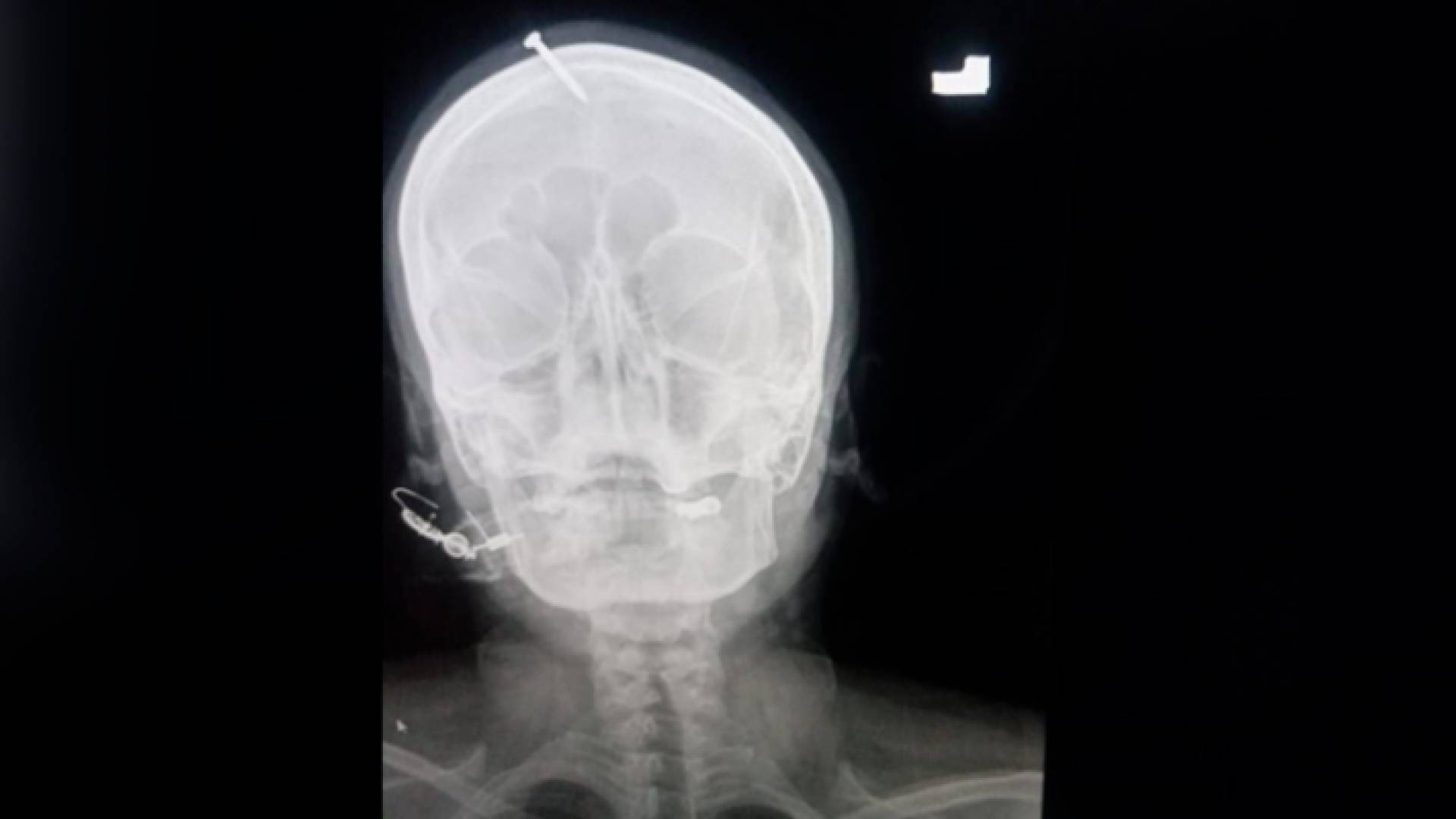 صورة أشعة لرأس المرأة الحامل