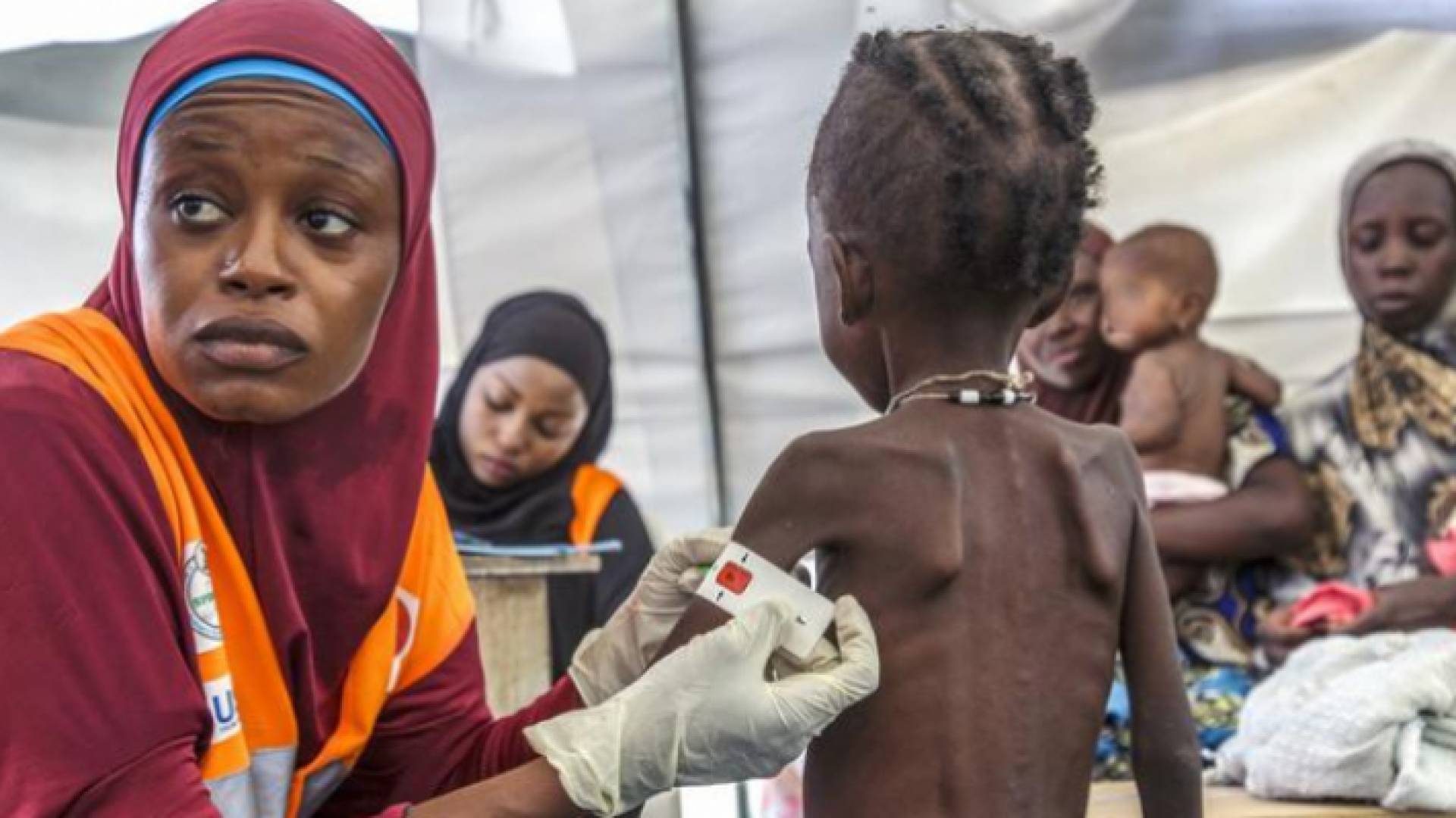 طفل يعاني من نقص التغذية - أرشيفية