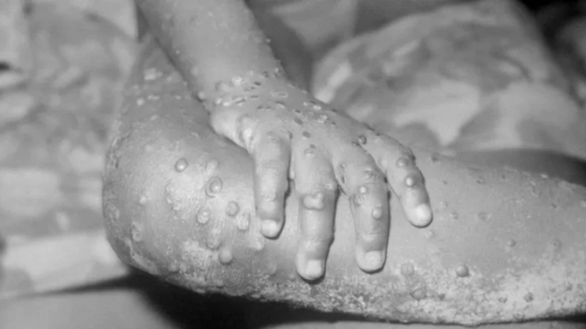 صورة تظهر الإصابة بجدري القرود