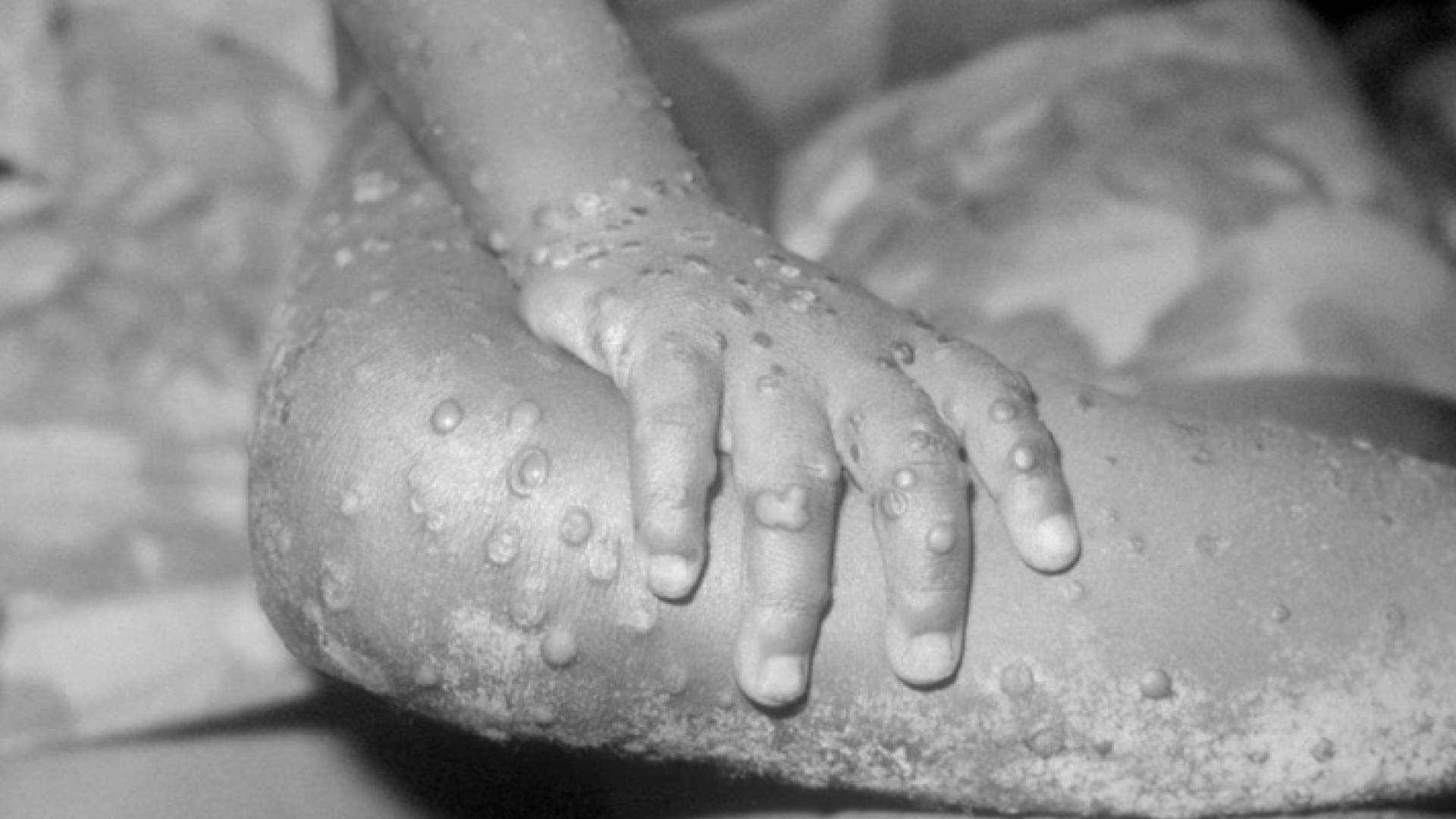 جدري القرود - تعبيرية