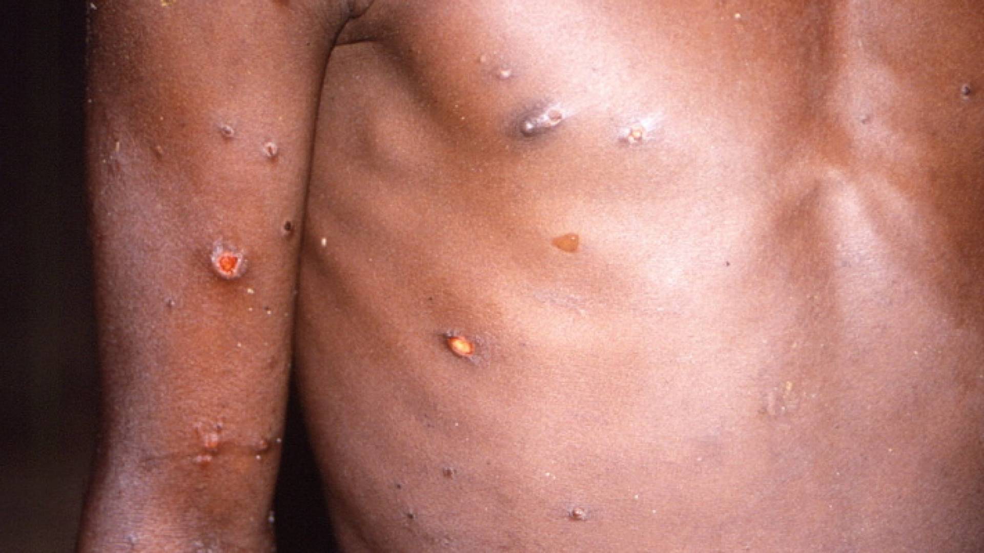 شخص مصاب بجدري القرود