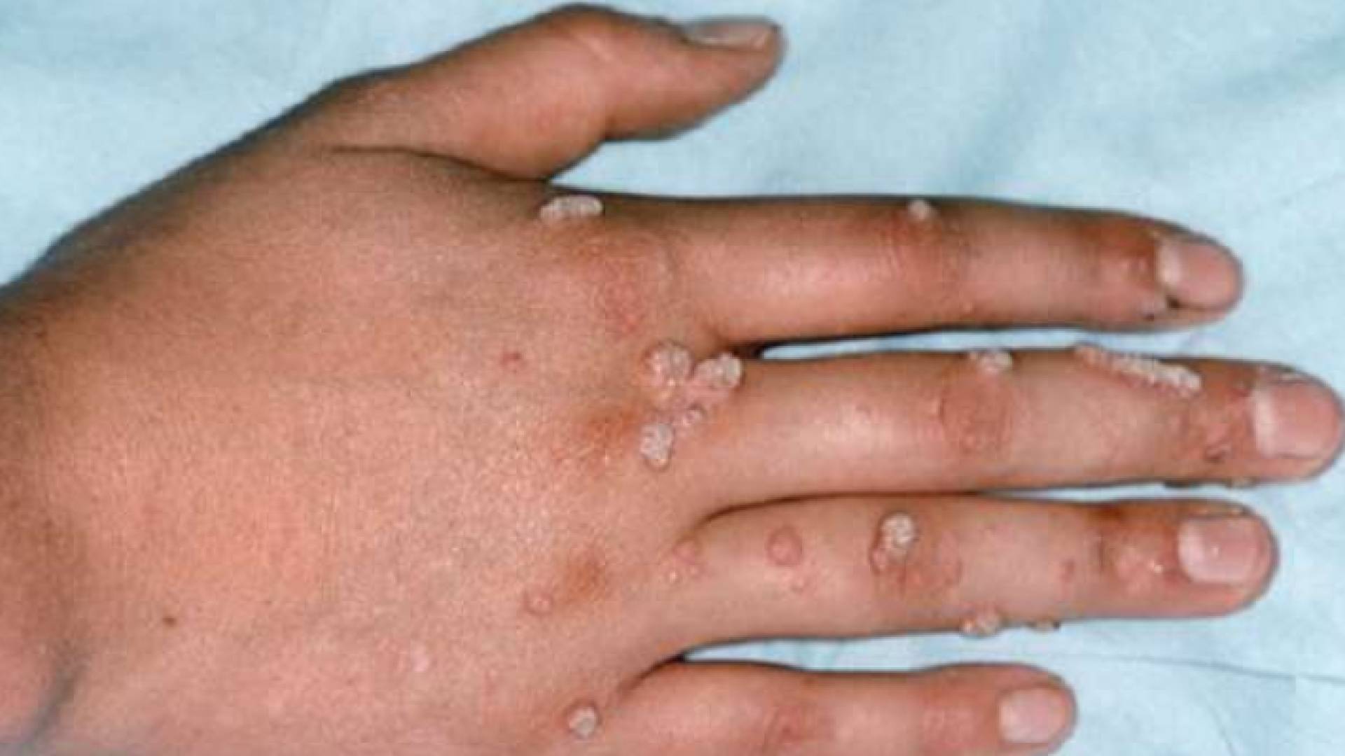 جدري القردة