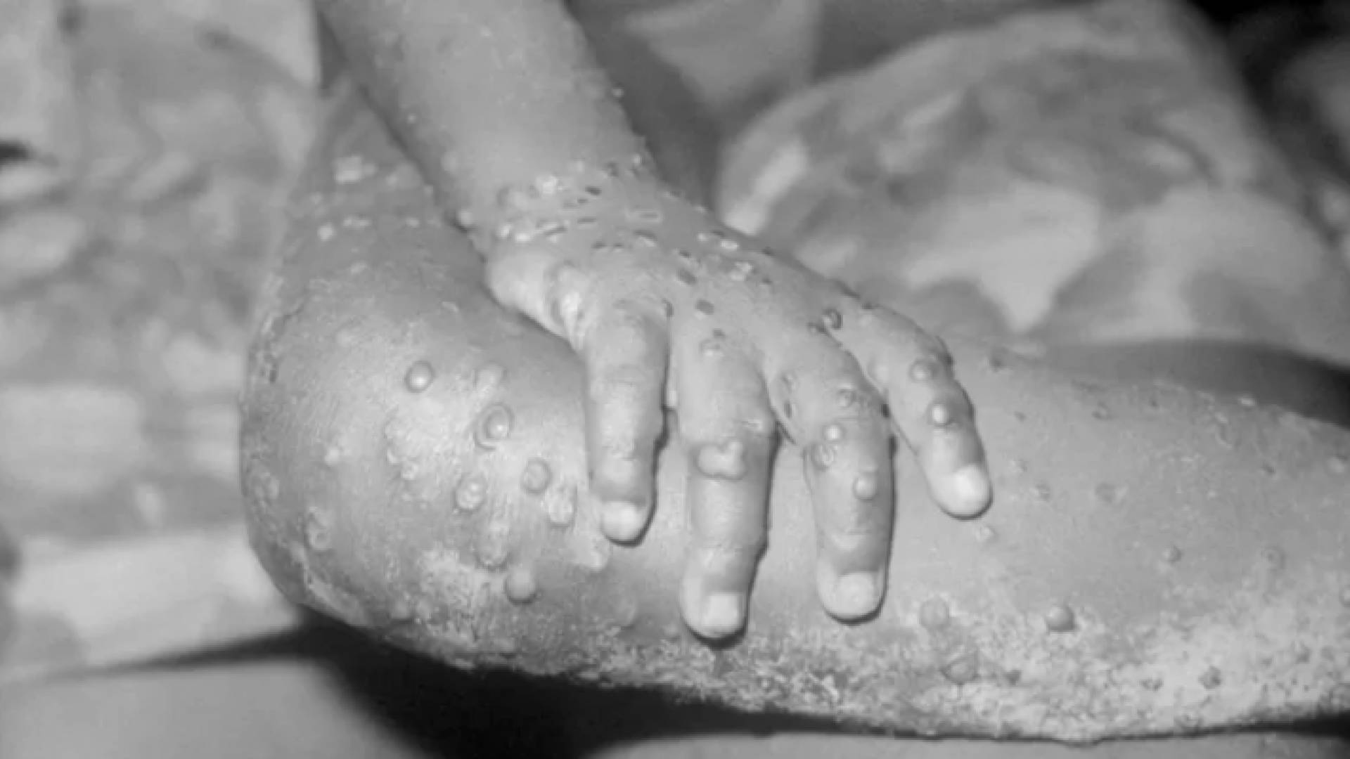 شخص مصاب بجدري القرود