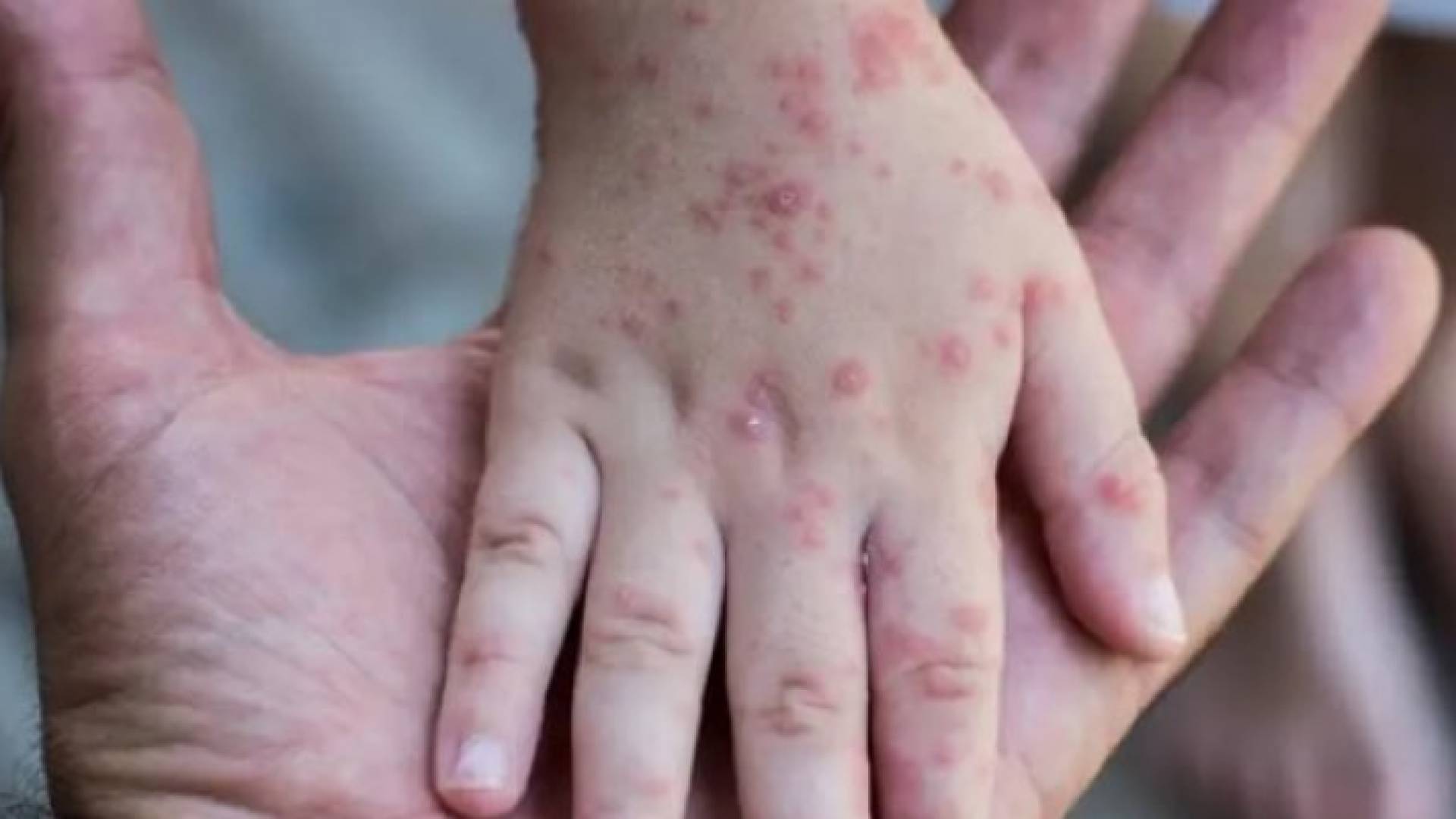 جدري القردة