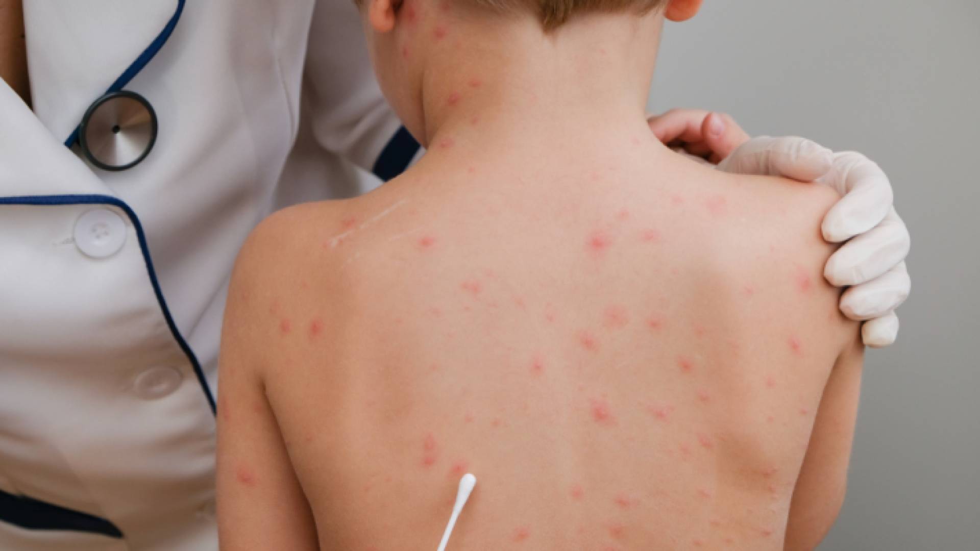 طفل مصاب بجدري القرود