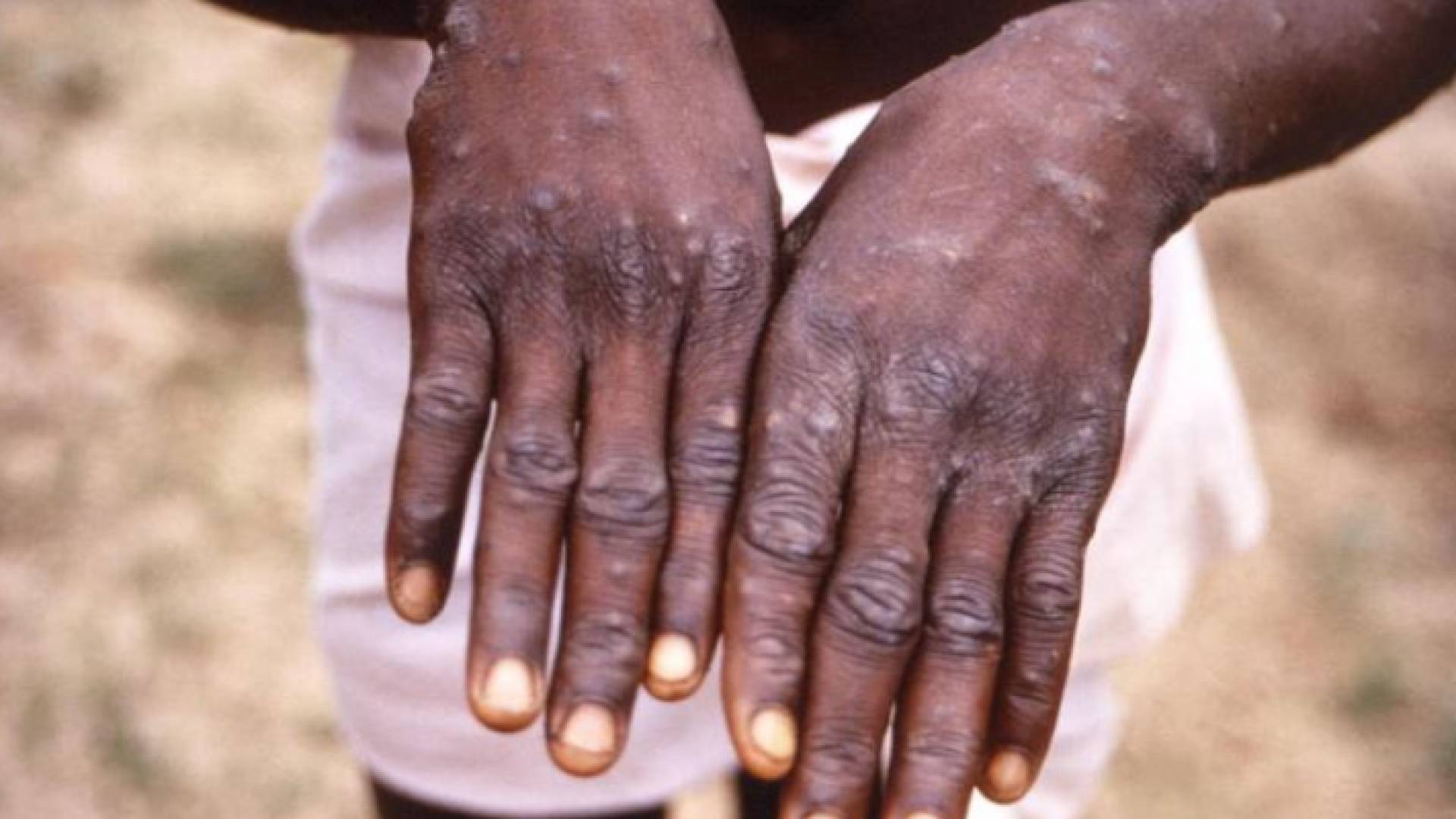 شخص مصاب بمرض جدري القرود