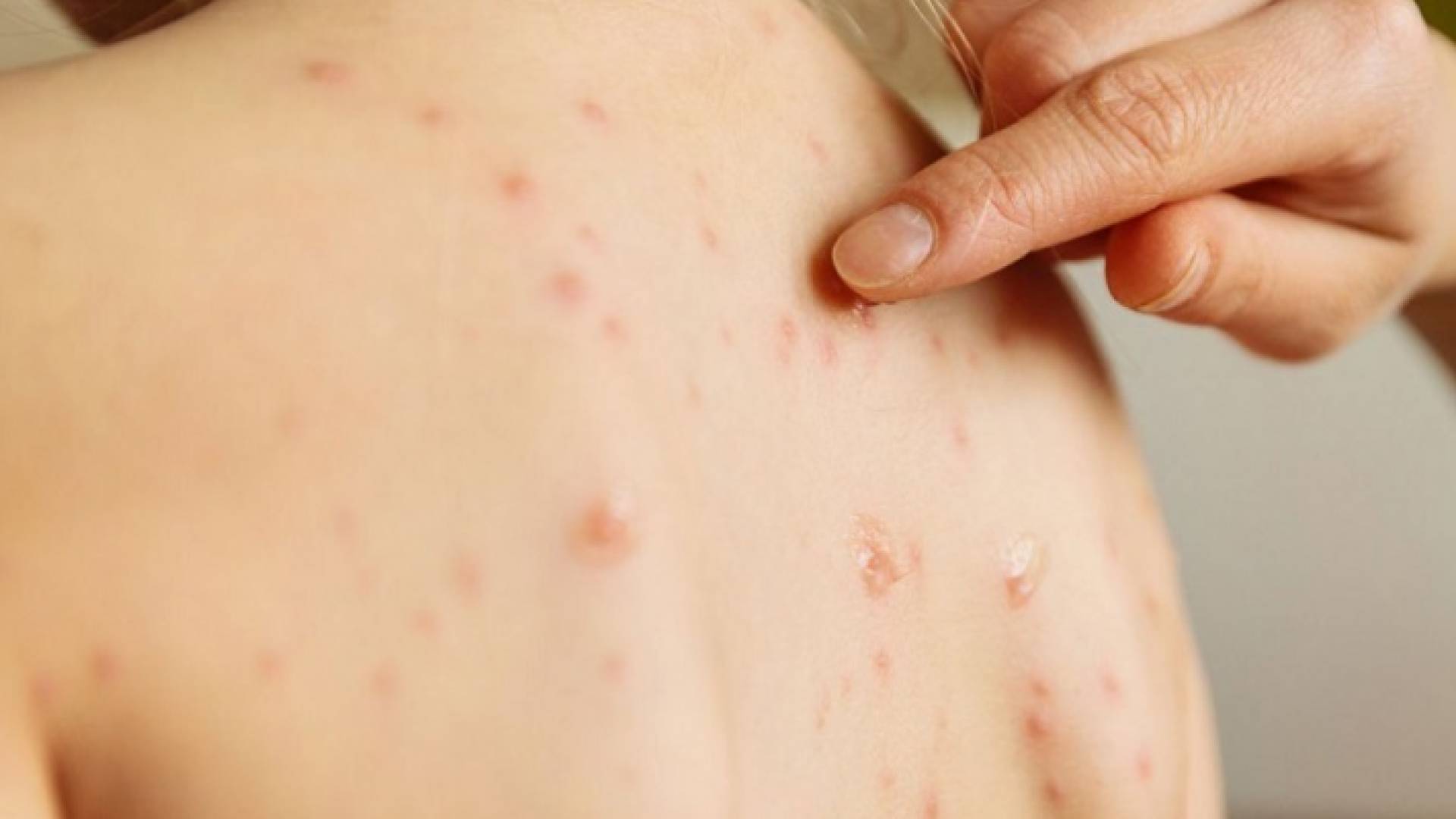 شحص مصاب بمرض جدري القردة