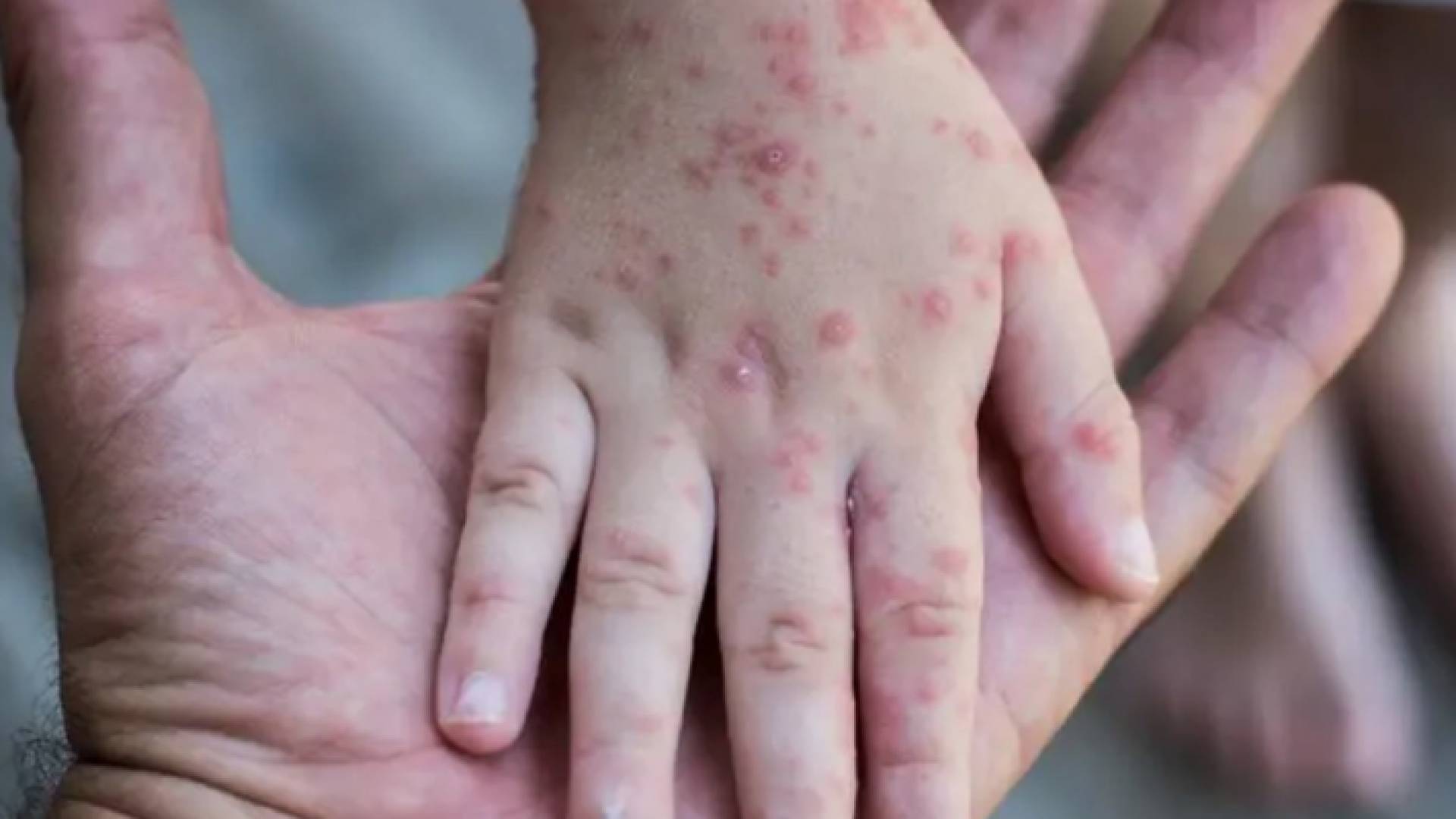 مصاب بجدري القرود