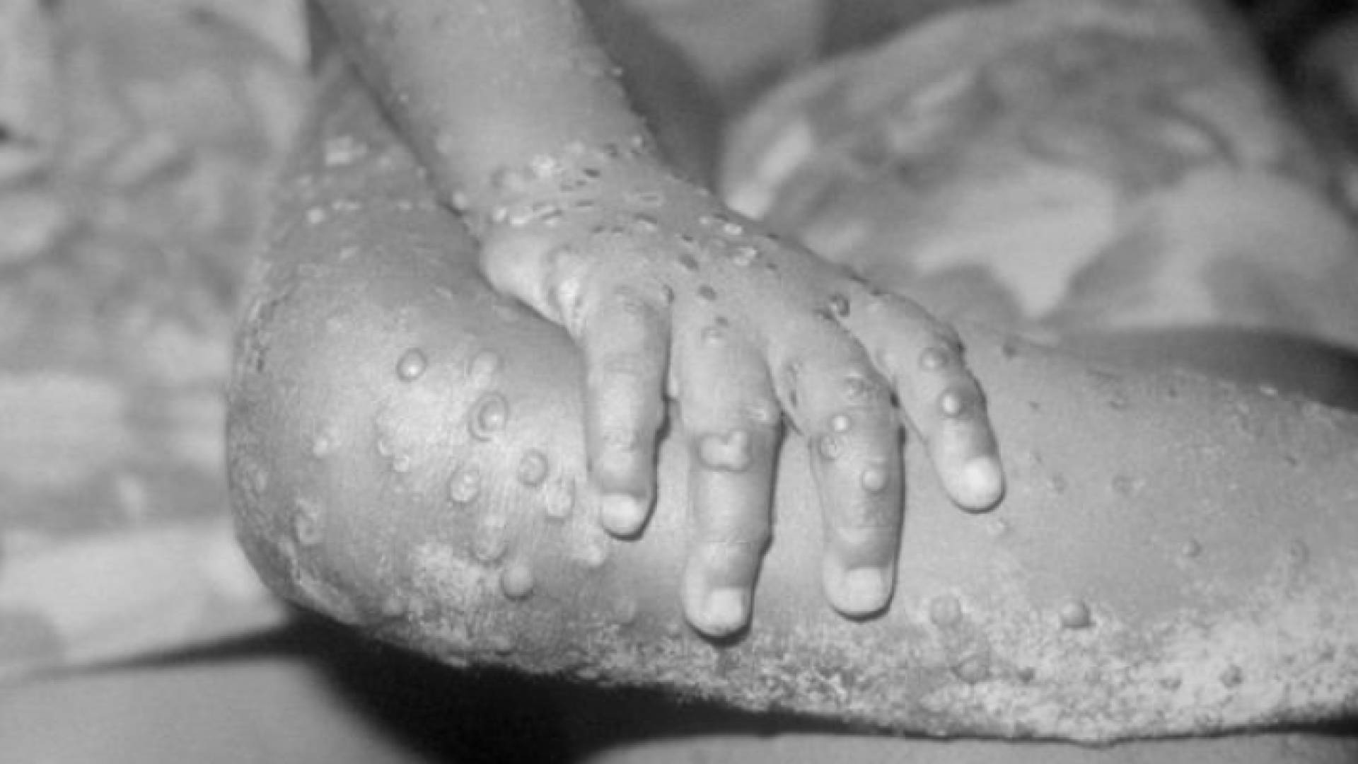 شخص مصاب بمرض جدري القردة