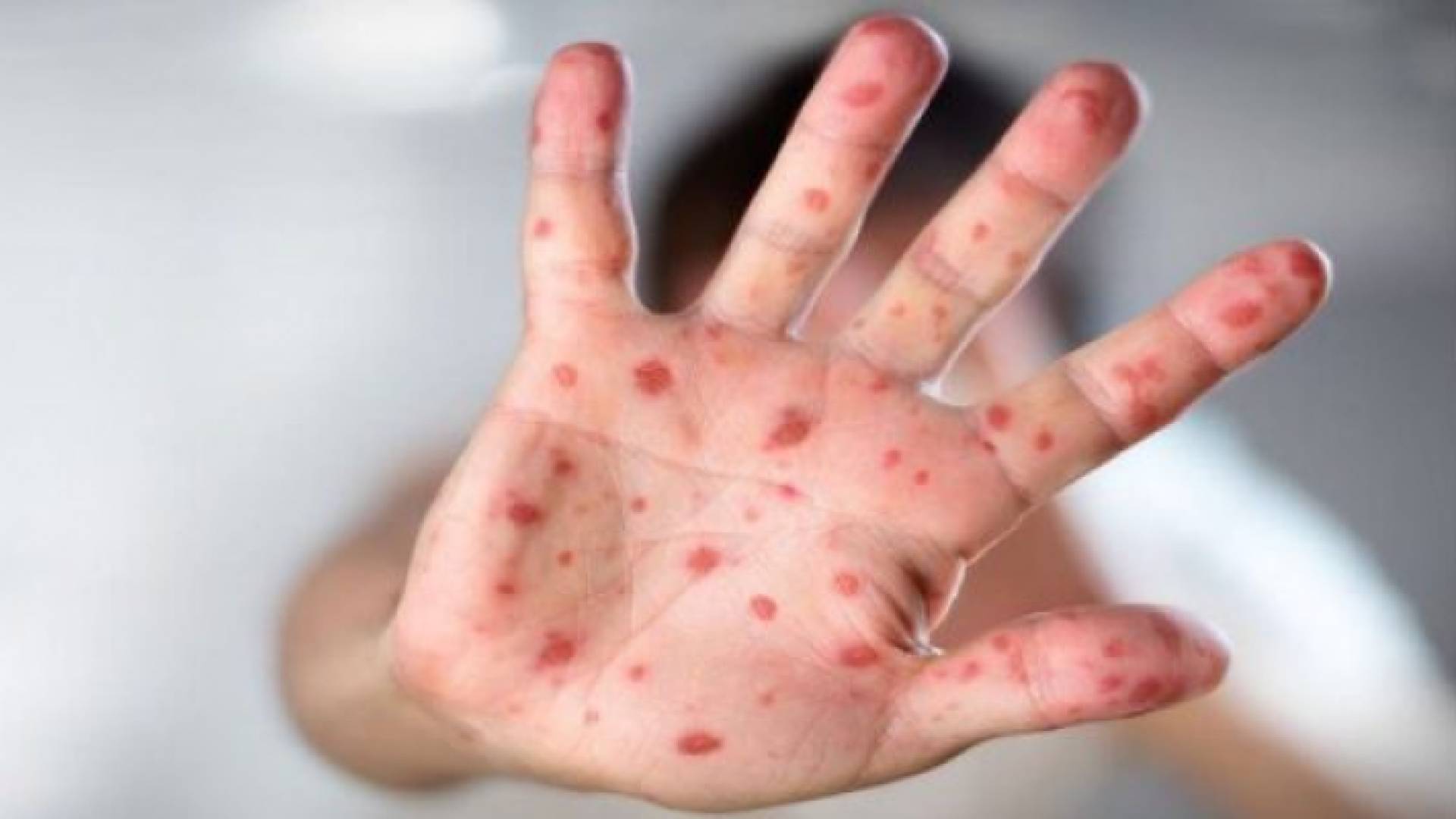 الطراونة: فترة العلاج من جدري القردة تصل إلى 4 أسابيع