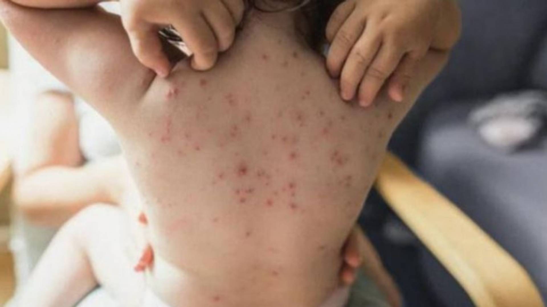 "الصحة العالمية" تنشر أعداد المصابين بجدري القرود حول العالم