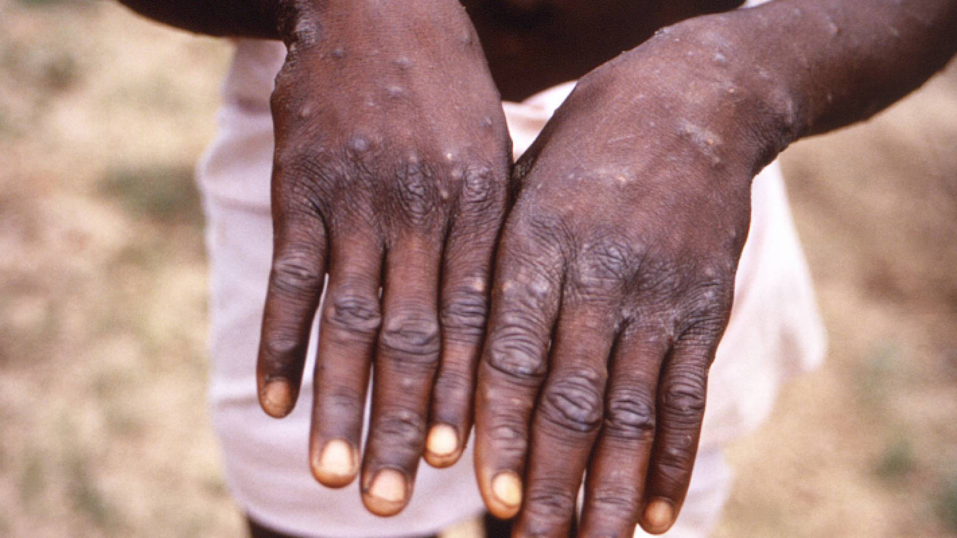 شخص مصاب بجدري القرود