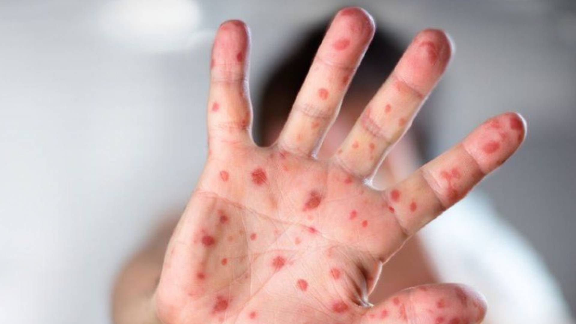 طفل مصاب بجدري القرود