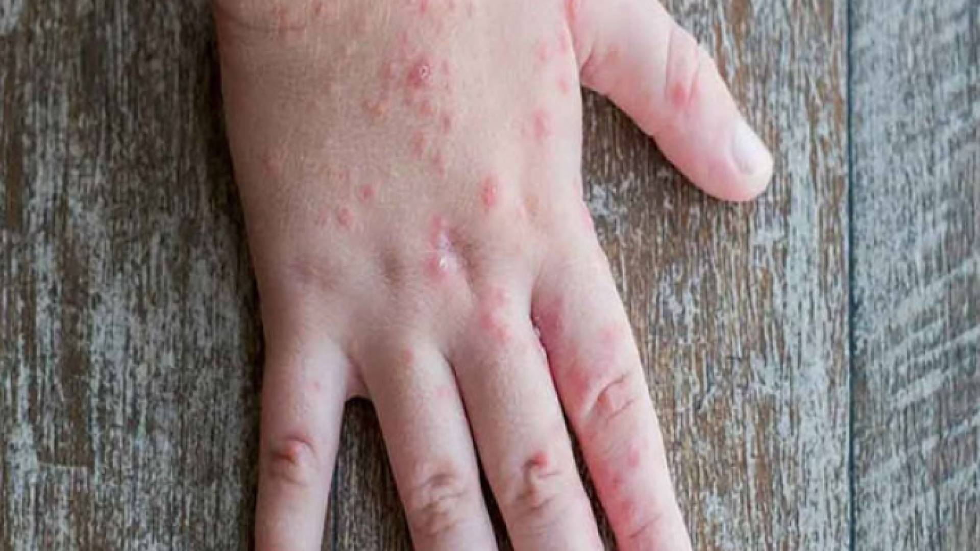 إنفلونزا الطماطم تسبب طفحا جلديا أحمر اللون وتهيج الجلد والجفاف والبثور