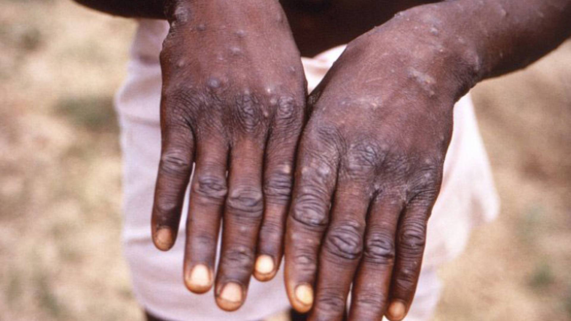 شخص مصاب بجدري القرود