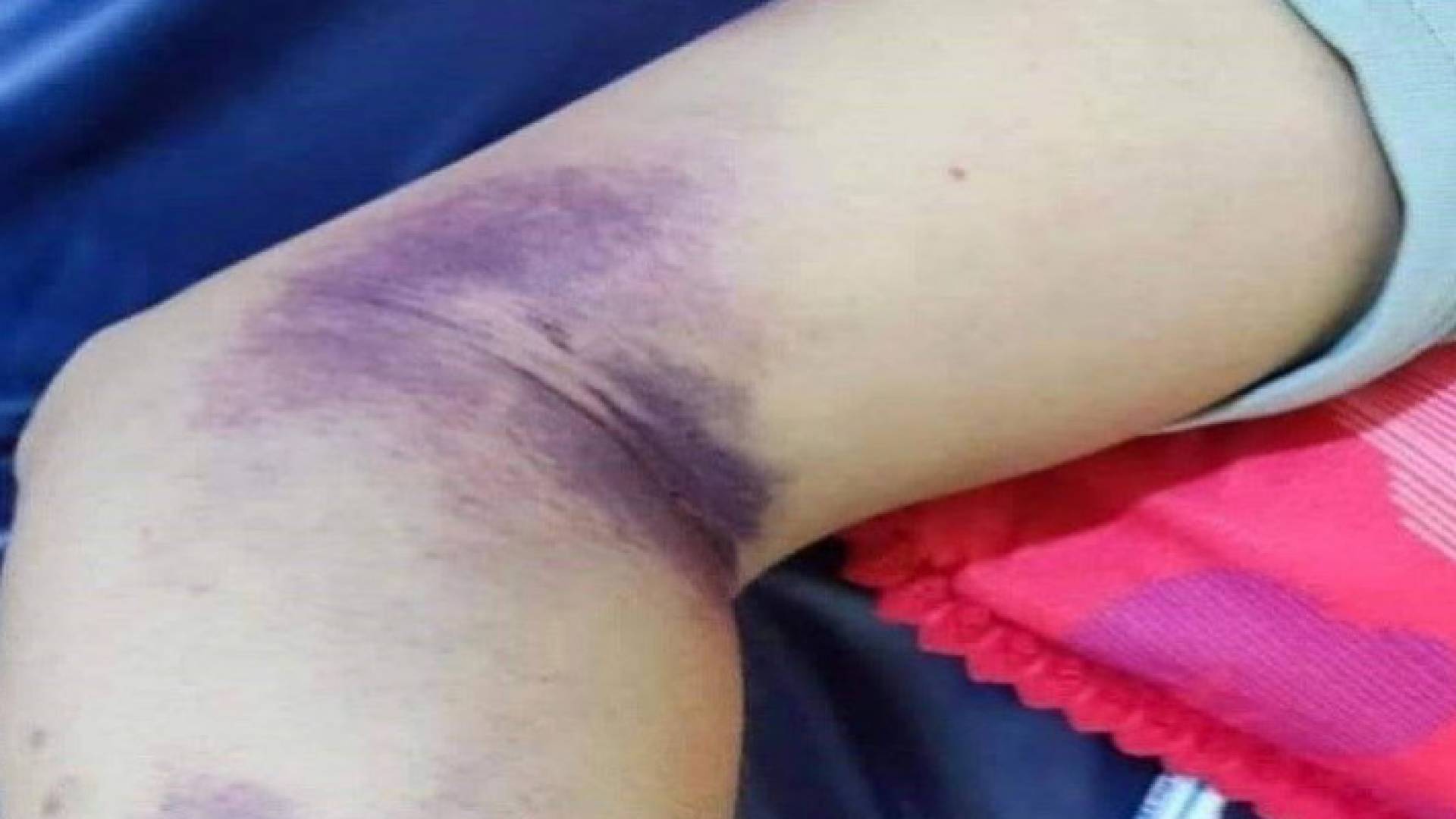 شخص مصاب بالحمى النزفية