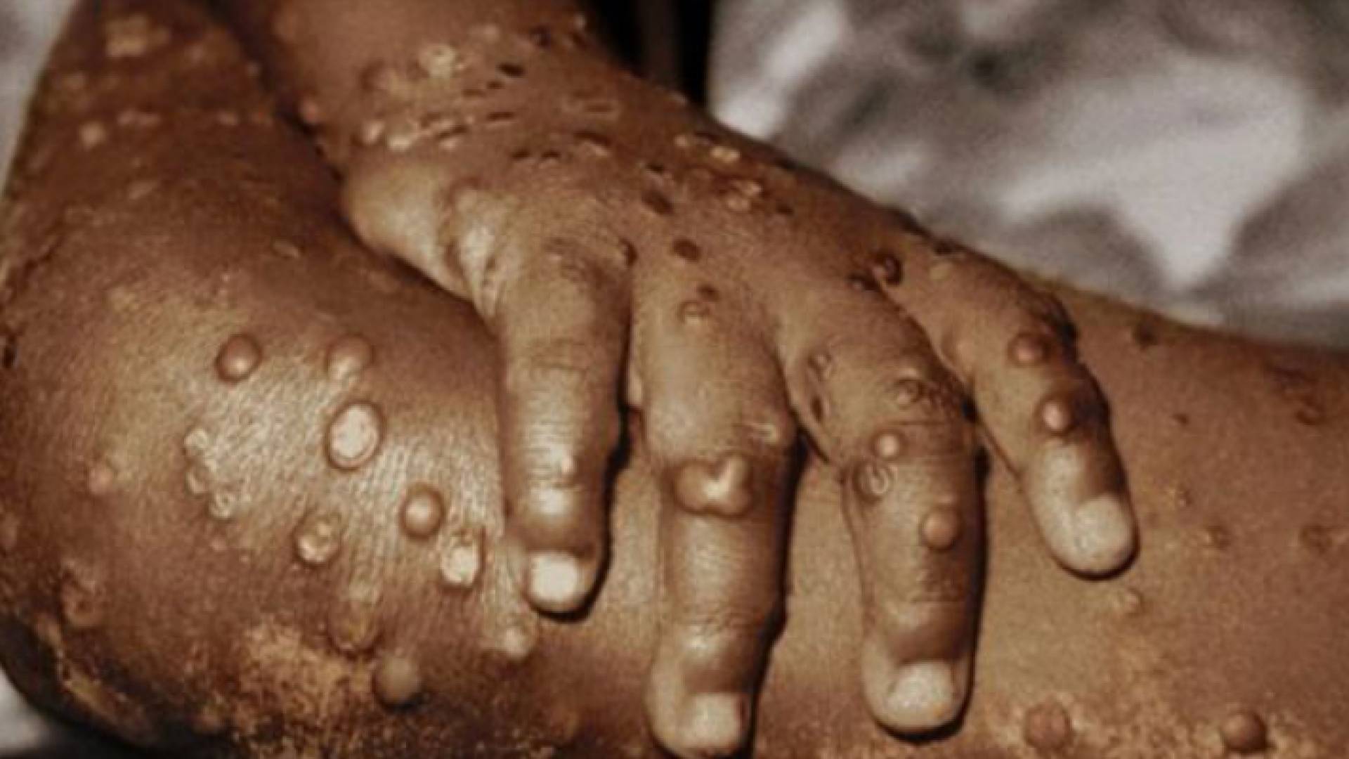 صورة توضيحية لشخص مصاب بجدري القرود