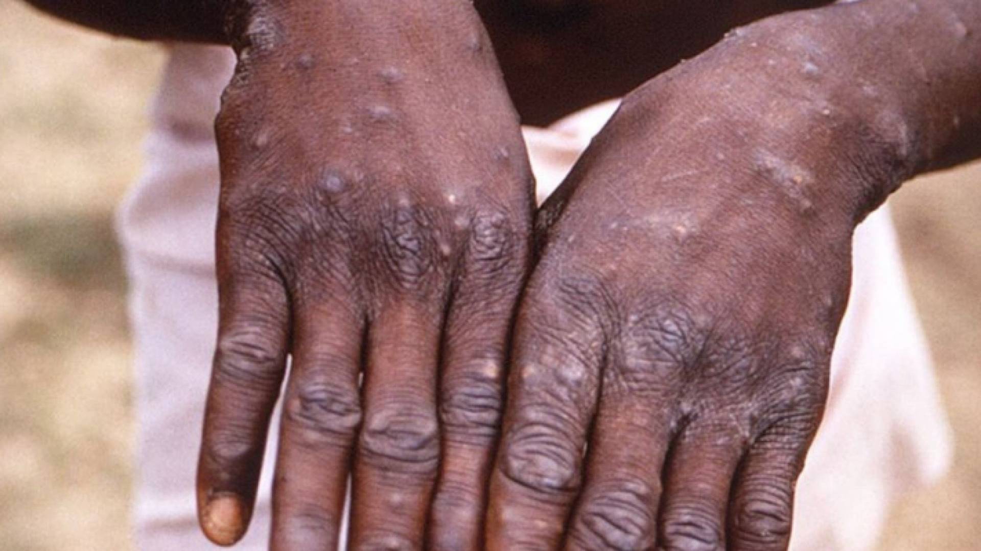 شخص مصاب بجدري القرود