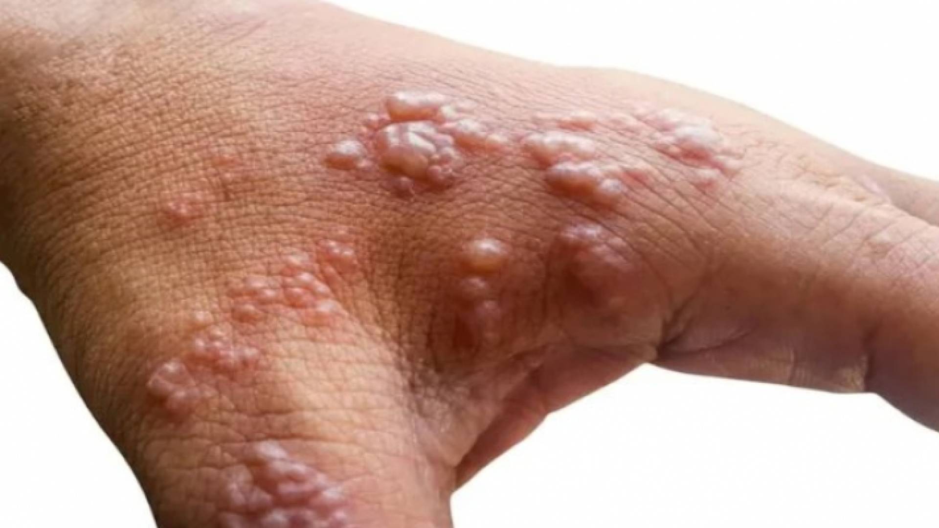 شخص مصاب بجدري القرود