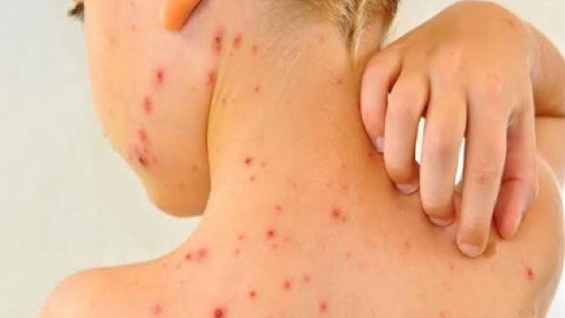 طفل مصاب بجدري القرود