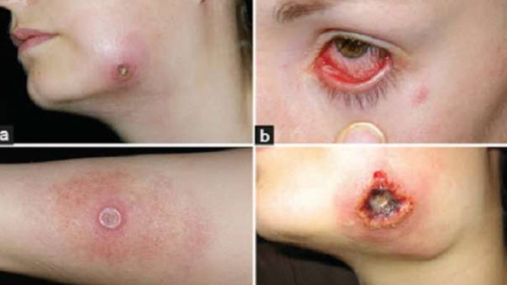 حبوب الجدري