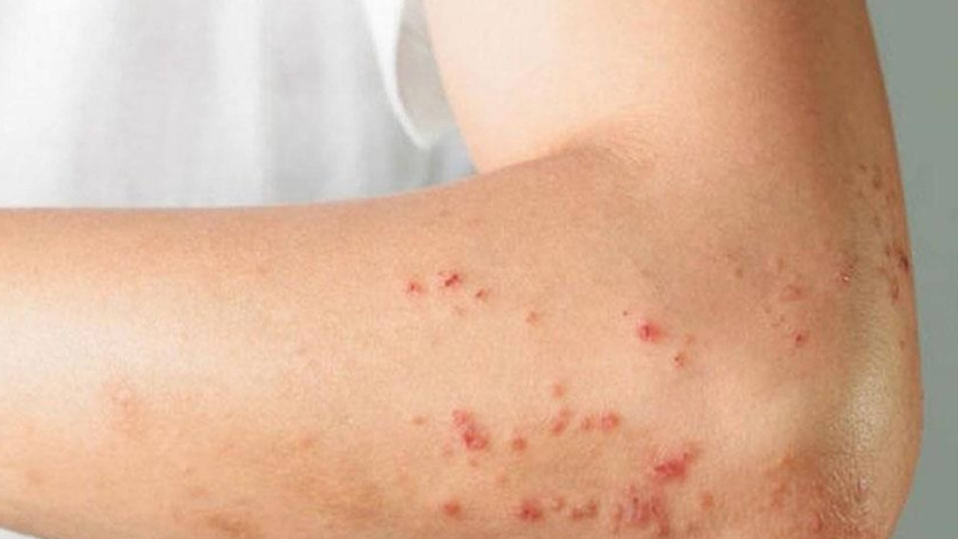 شخص مصاب بجدري القرود