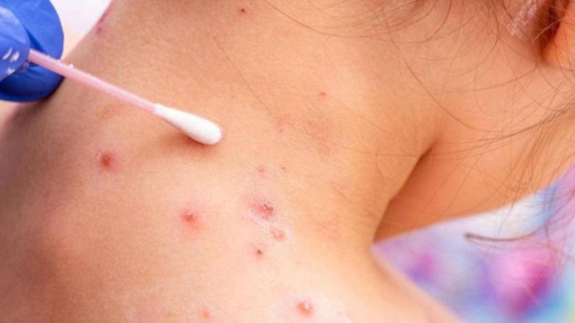 مصابة بجدري القرود