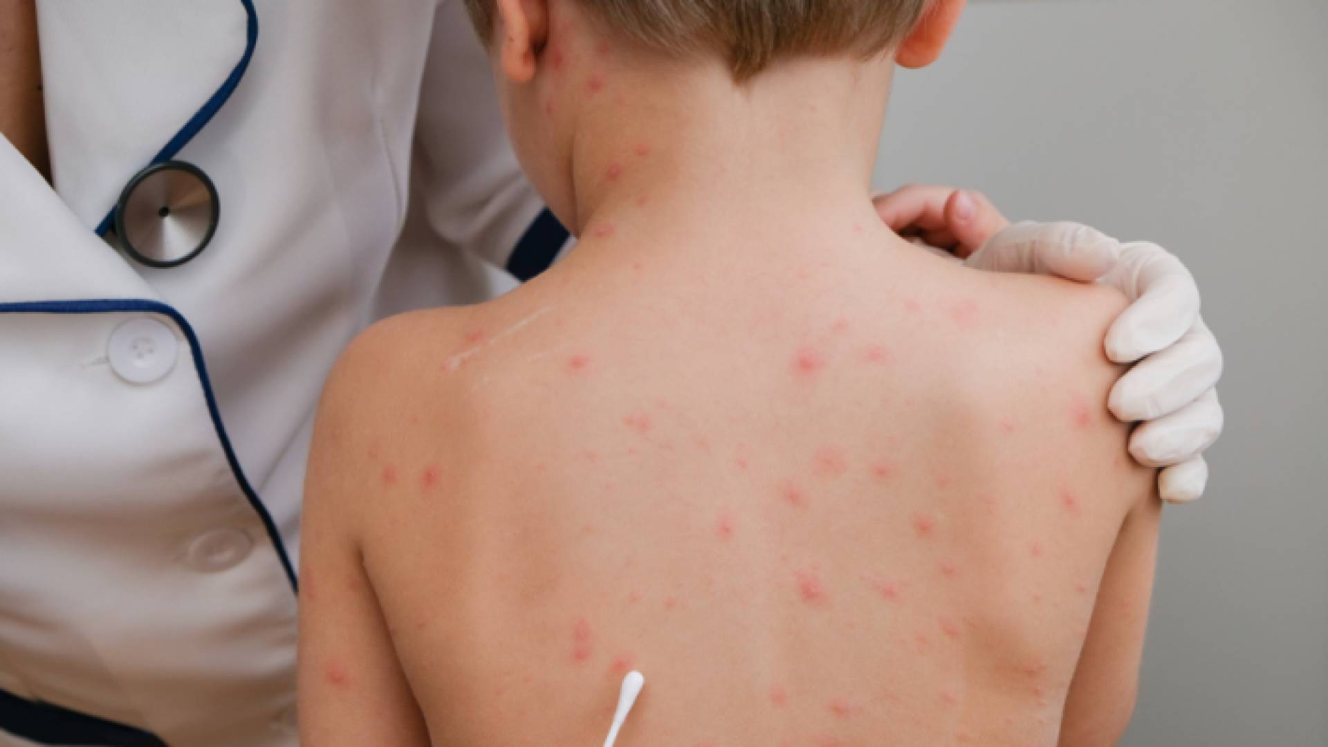 جدري - تعبيرية