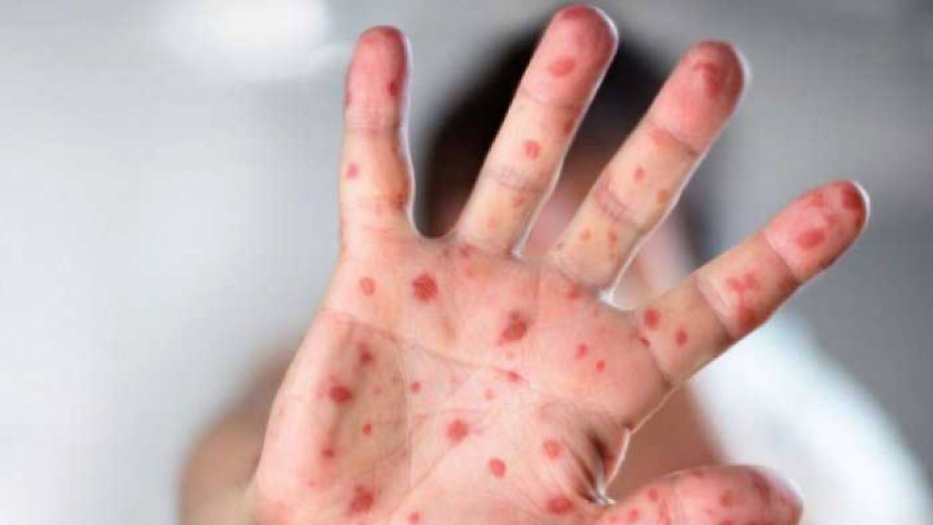 شخص مصاب بجدري القرود