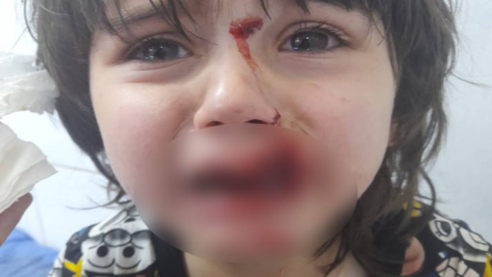 الطفل محمد العيسى المتعرض لعقر كلب في المفرق