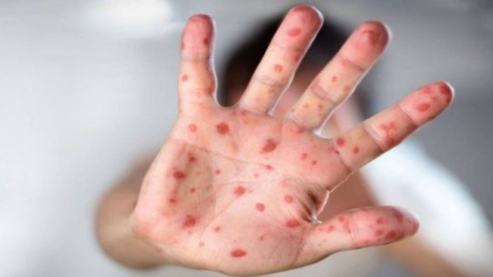 جدري القردة