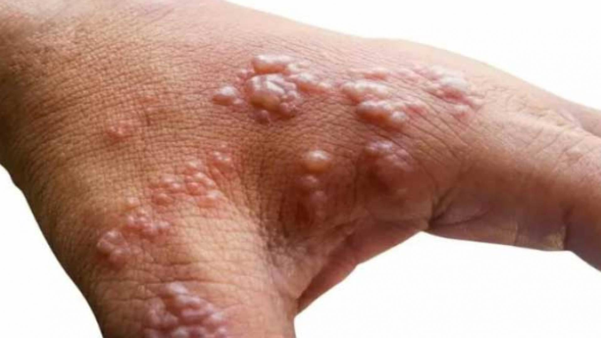 شخص مصاب بجدري القرود