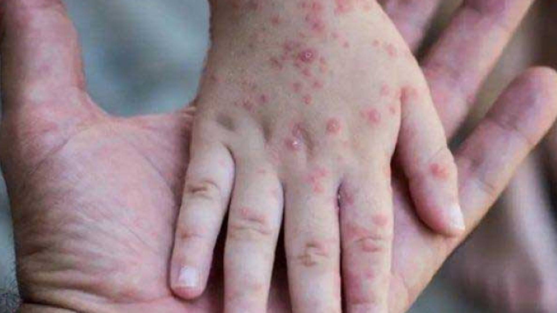 طفل مصاب بجدري القرود