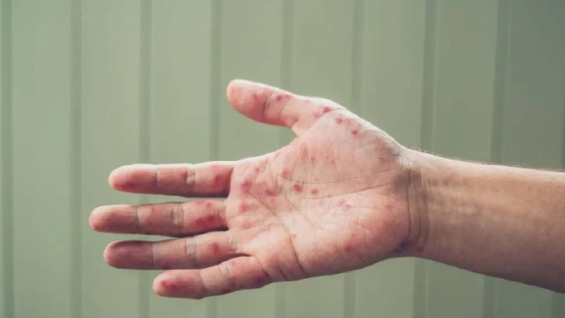 صورة توضيحية لطفح جلدي وبثور