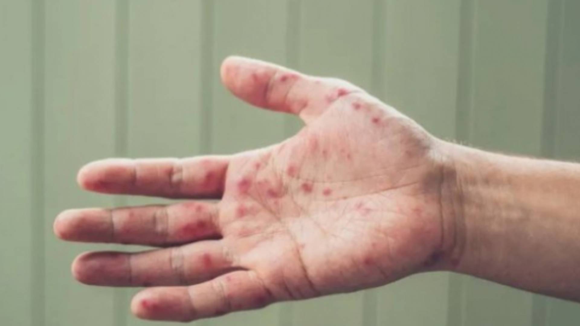 مصاب بجدري القرود