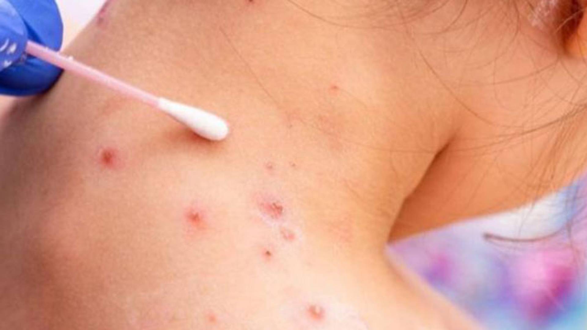 حالة مصابة بجدري القرود