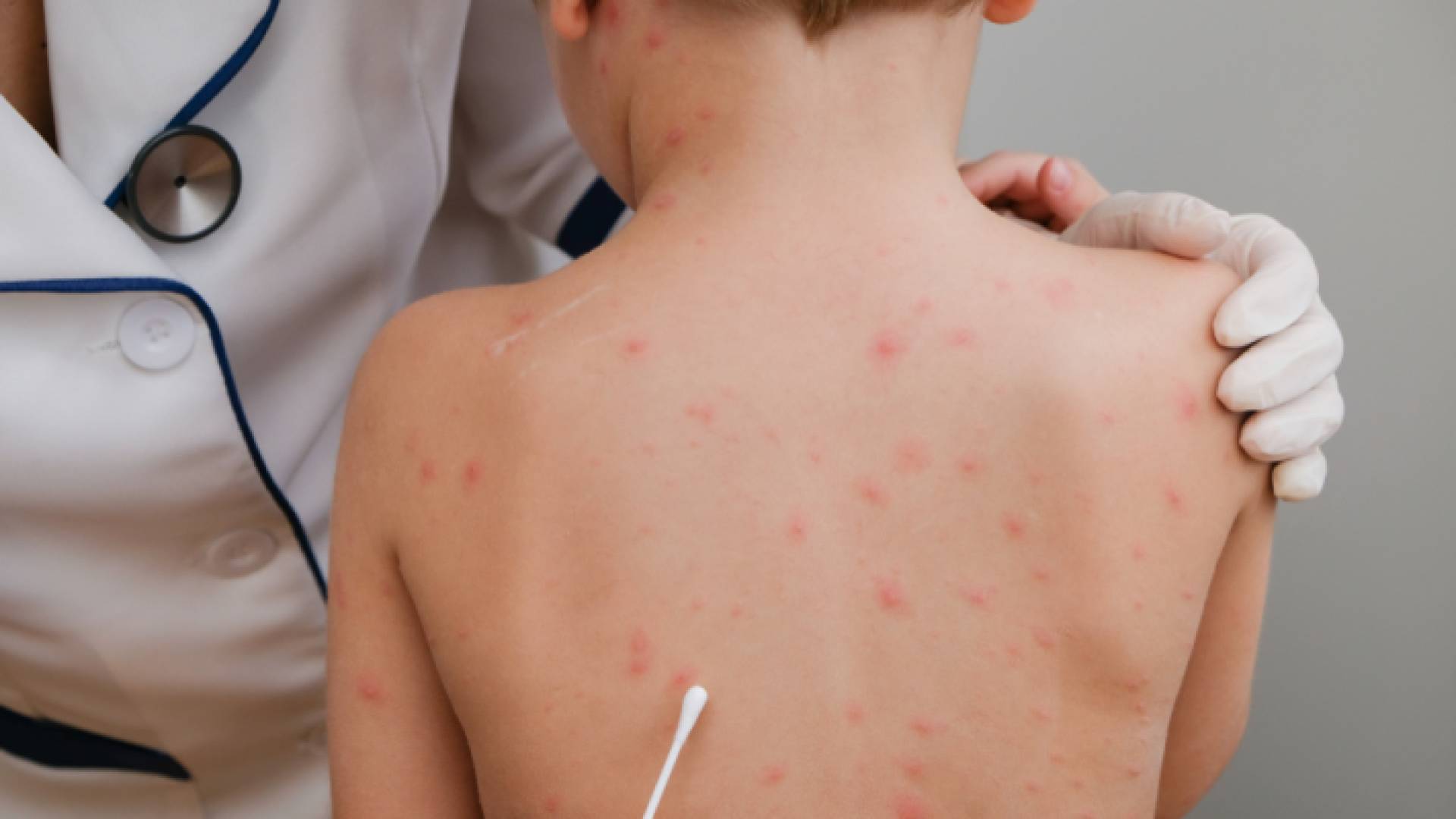 طفل تظهر عليه أعراض الإصابة بجدري القرود