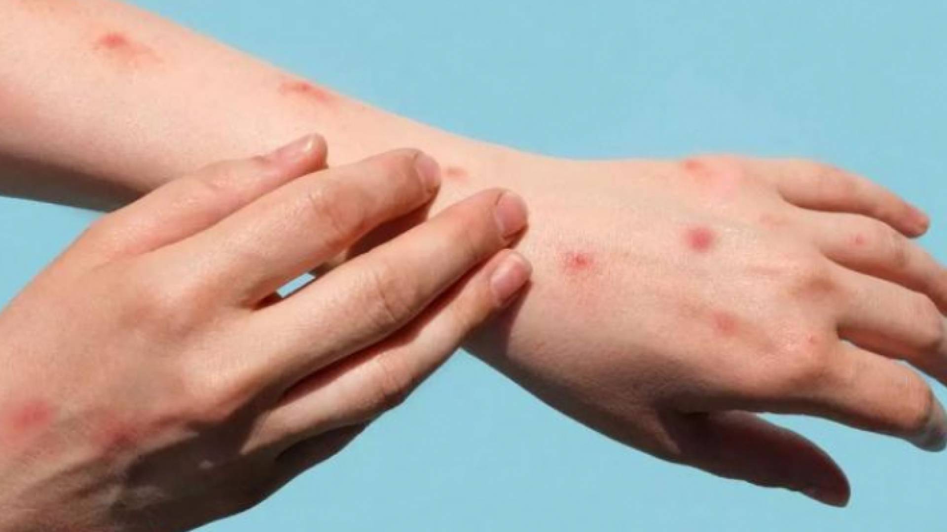 شخص يعاني من طفح جلدي لإصابته بجدري القرود