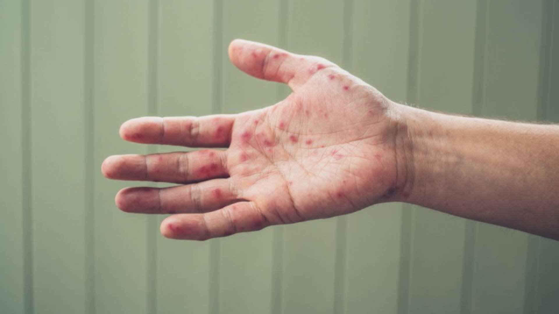 شخص مصاب بجدري القرود