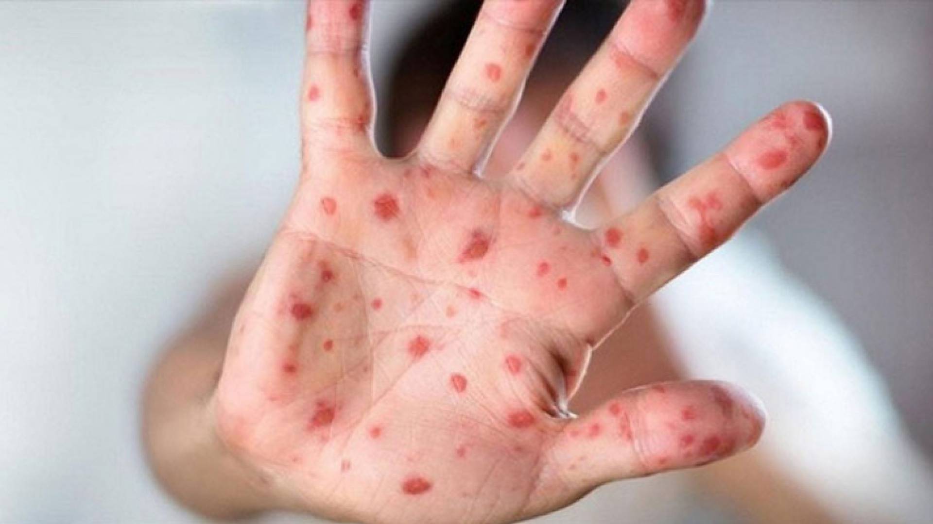 شخص مصاب بجدري القرود