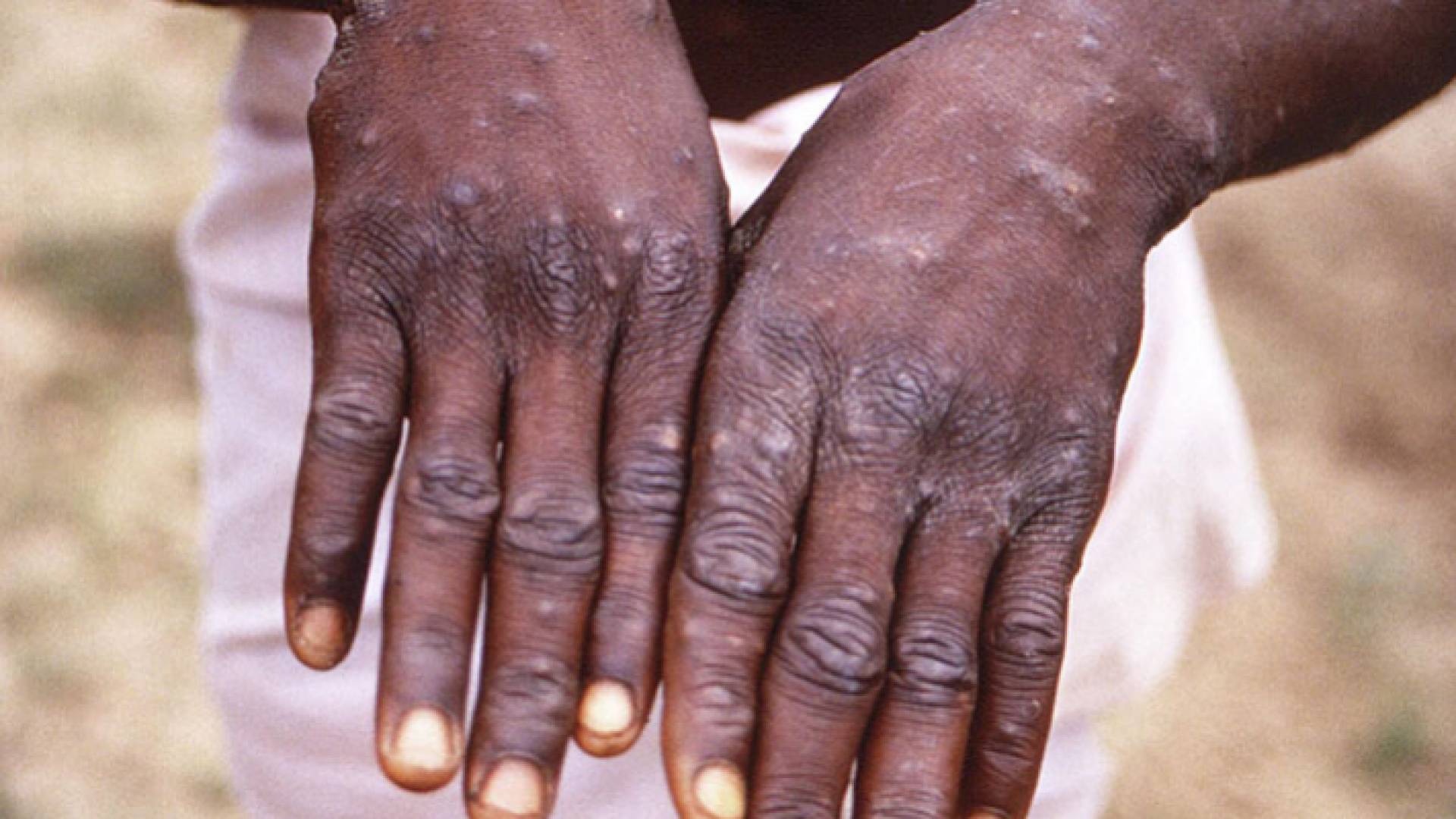 يدا شخص مصاب بجدري القرود