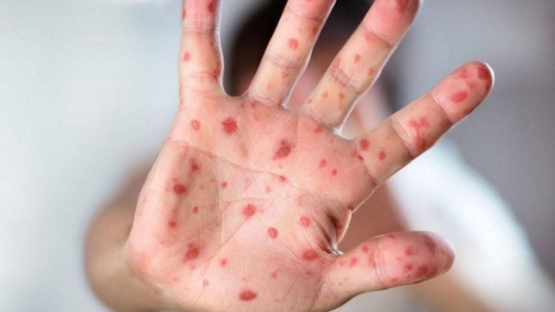 صورة ارشيفية لجدري القرود