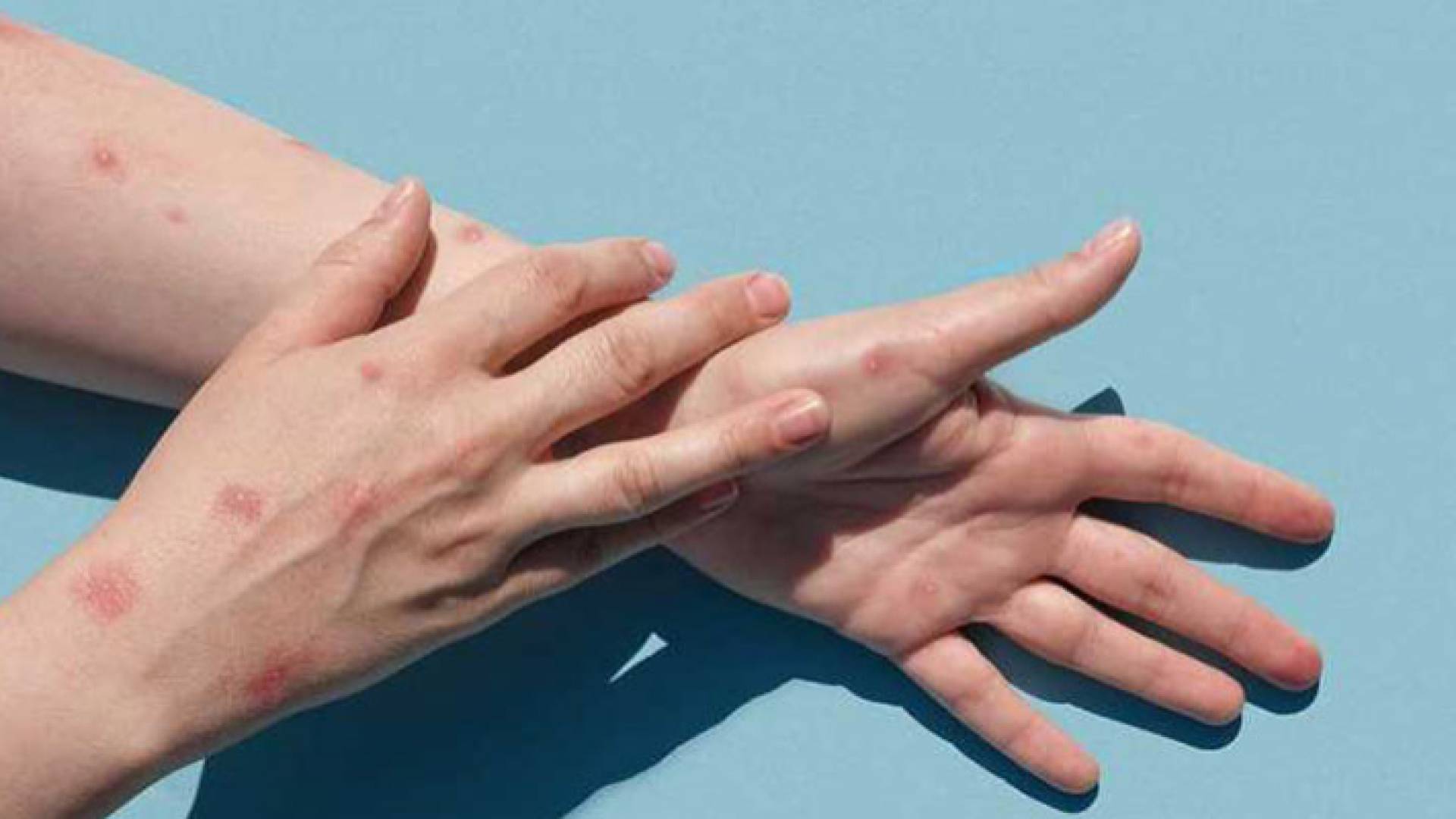 صورة ارشيفية لجدري القرود