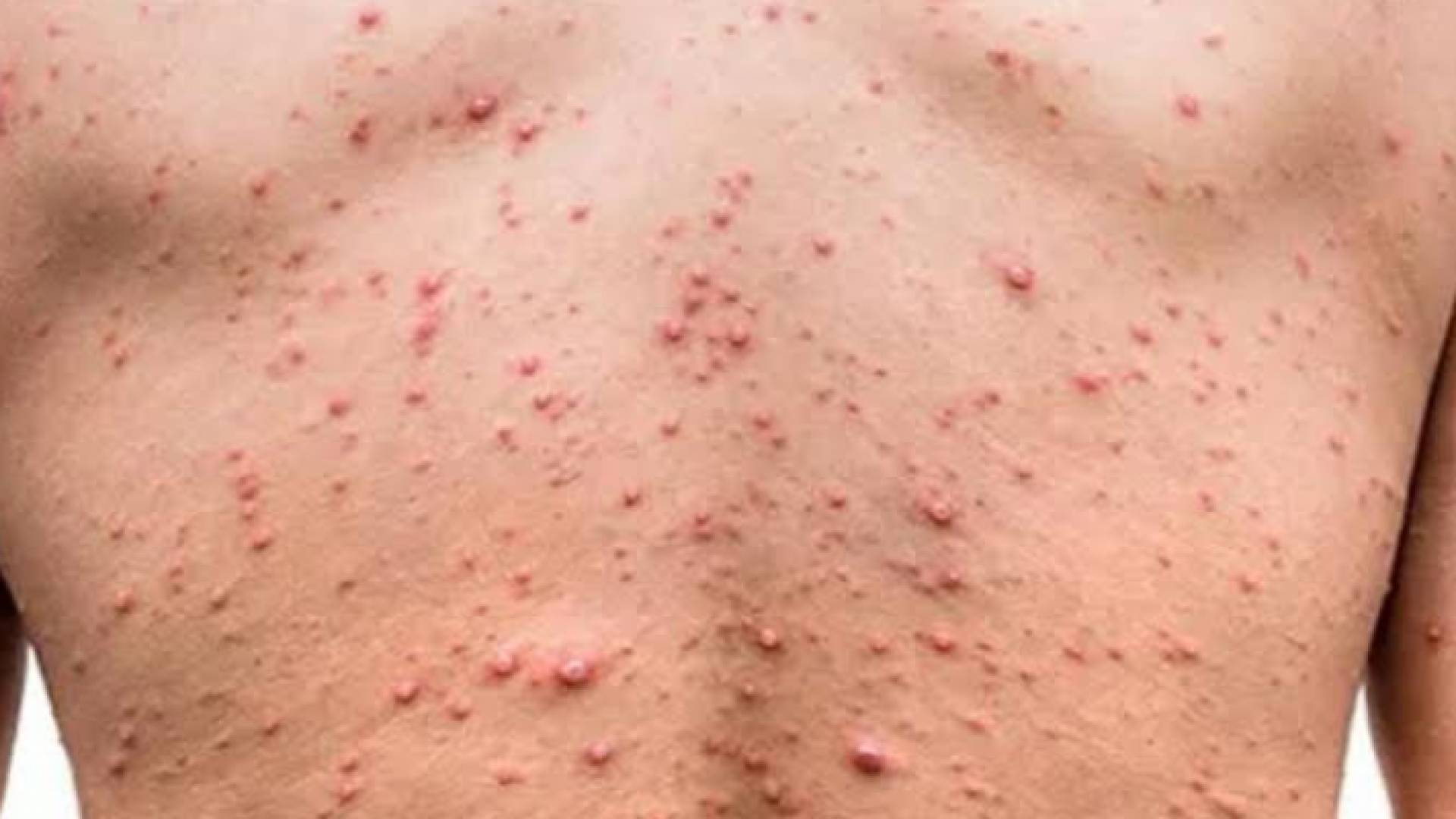 شخص مصاب بجدري القرود