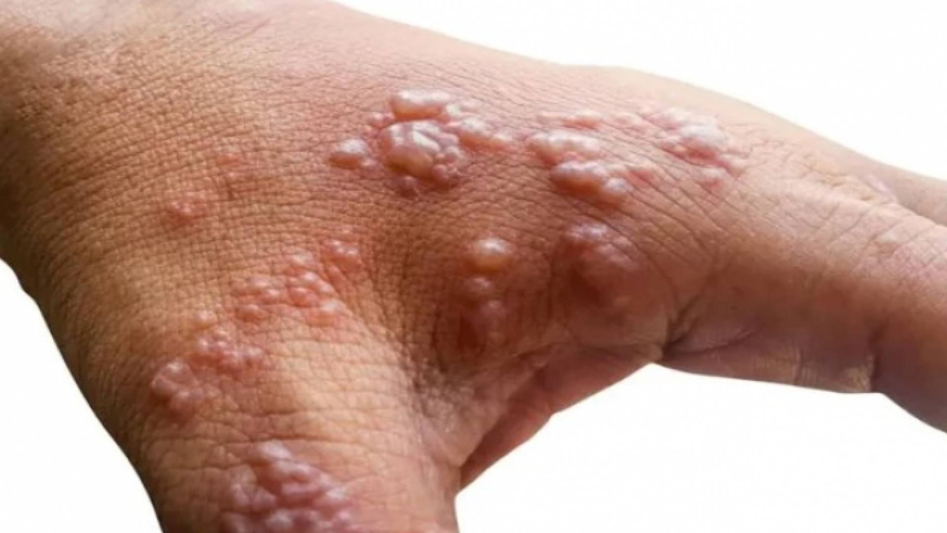 شخص مصاب بجدري القرود