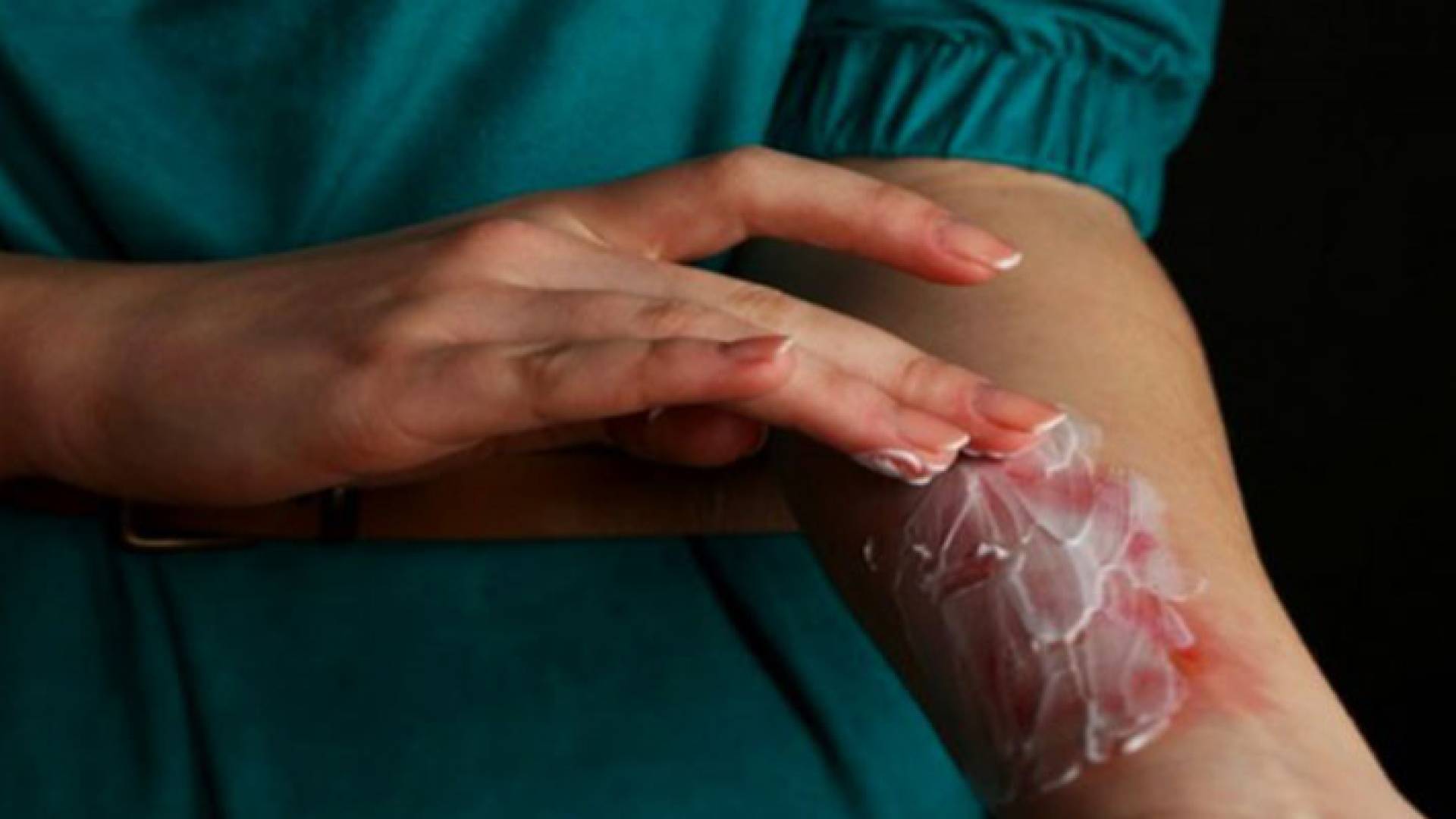 حرق - تعبيرية