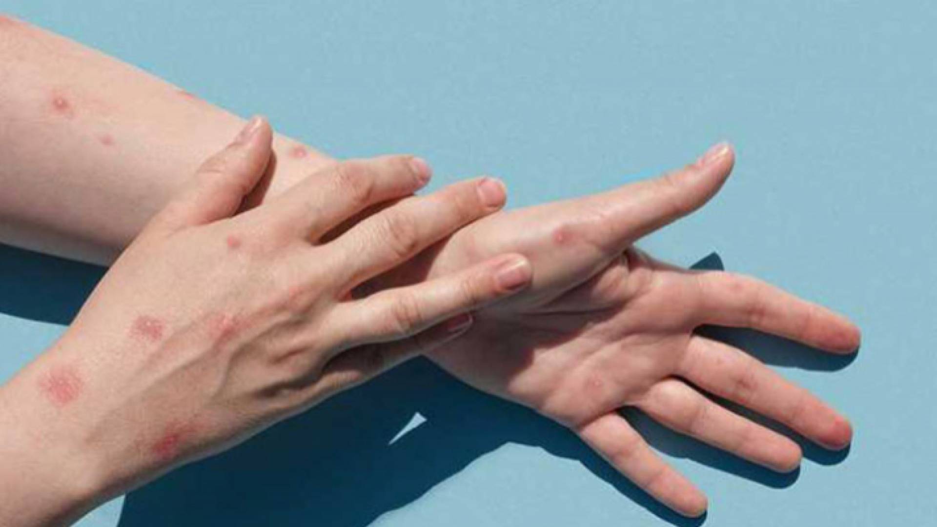 صورة توضيحية لطفح جلدي وبثور