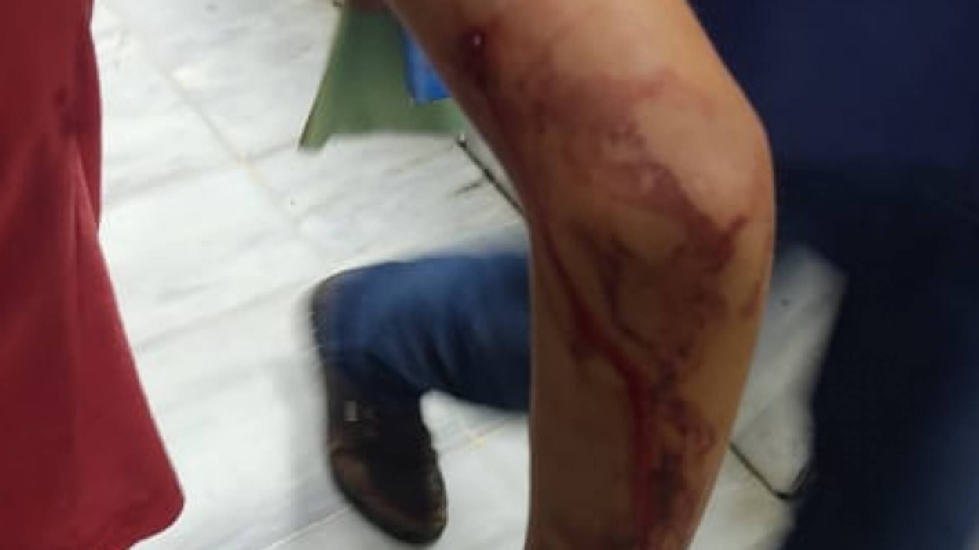 أحد الأطفال المعقورين من الكلب الضال في إربد